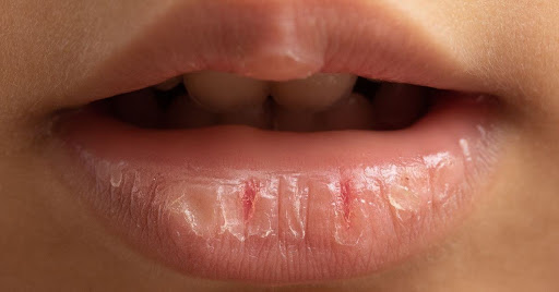 Chapped Lips: Causes, Remedies, and Prevention Tips for Winter