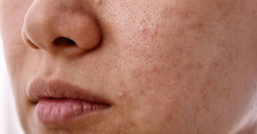 Can Stress Affect Your Skin? Understanding the Link Between Stress and Skin Problems