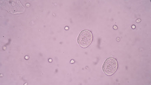 Epithelial Cells in Urine: Normal Range, Causes, and When to See a Doctor