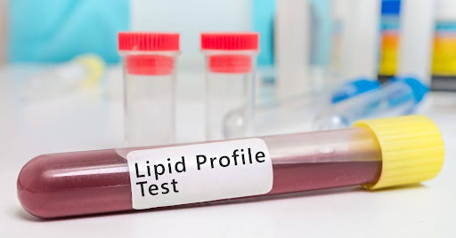 Lipid Profile Tests: Parameters, Preparation, and Health Importance
