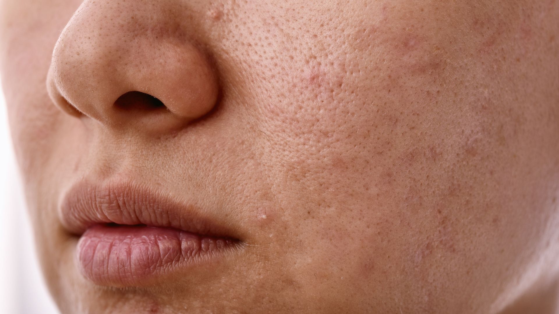 Common Monsoon Skin Problems and their Remedies