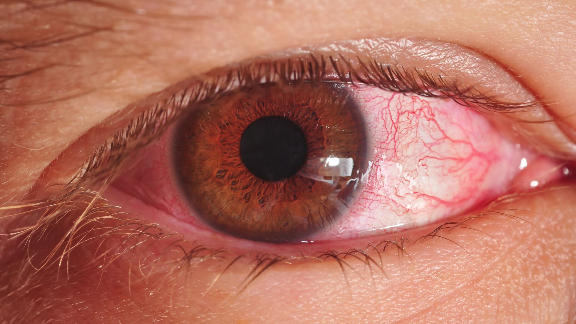 7 Tips To Prevent Conjunctivitis(Pink Eye) 2023