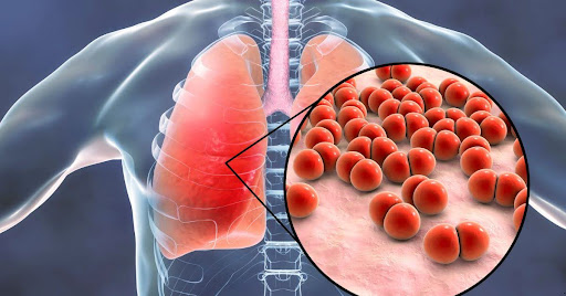 Understanding Pneumonia: Causes, Types, Symptoms, and Recovery Duration