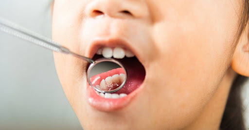 Tooth Cavities Explained: Causes, Symptoms, and Prevention Strategies