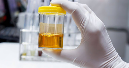 Why Regular Urine Analysis is Important for Your Overall Well-being