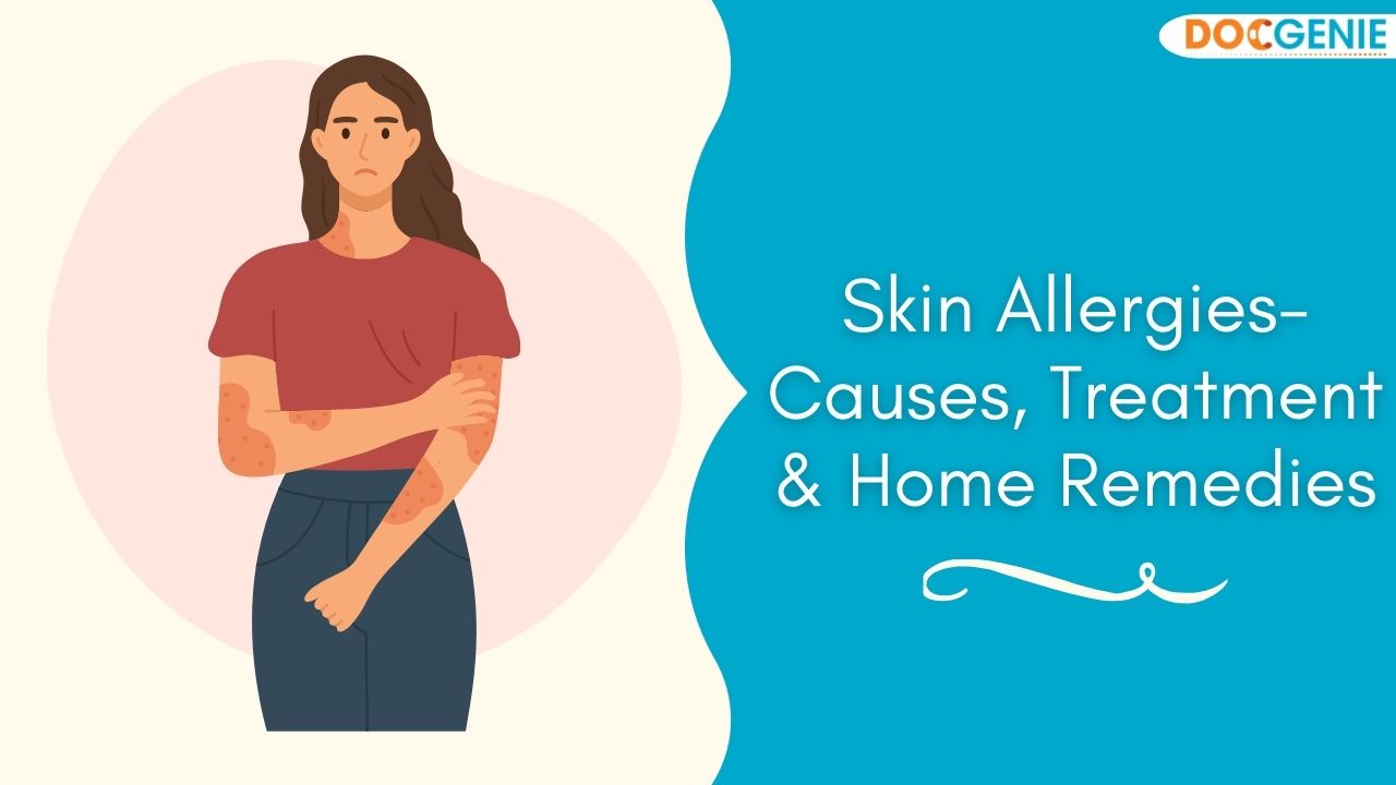 Skin Allergies – Causes, Treatment, Home Remedies