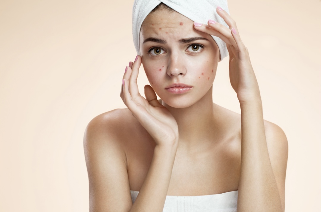 How to manage your acne and stay acne free