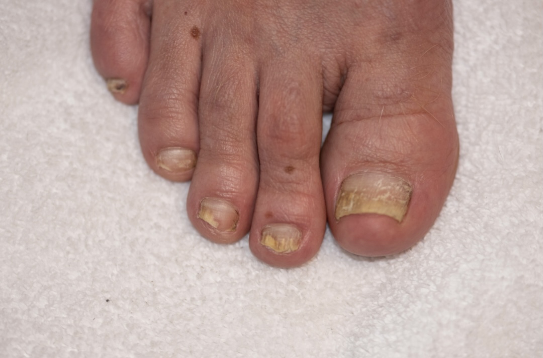 What is Onychomycosis and Nail Treatment?