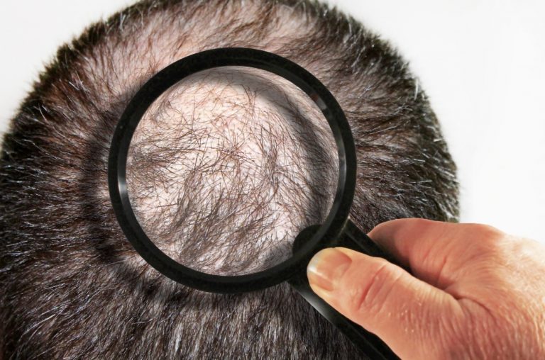 Most common types of hair loss