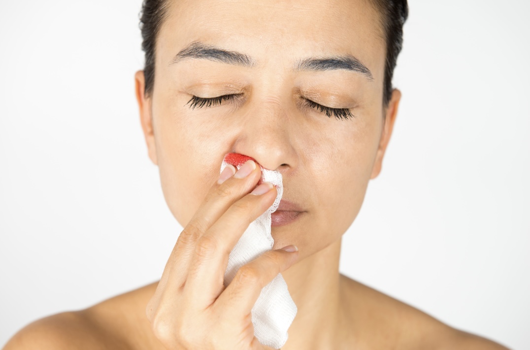 Nosebleed Or Epistaxis: Symptoms Causes Treatment