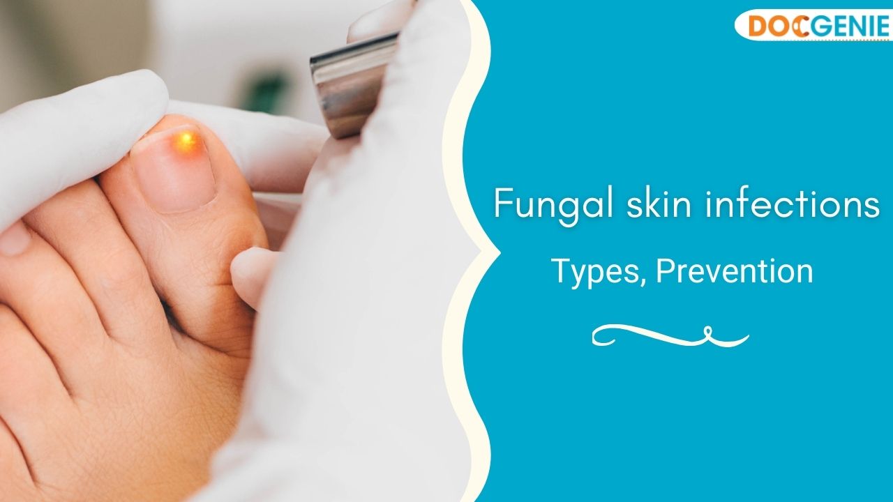 Fungal Skin Infections: Types, Prevention