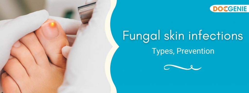 Fungal skin infections - docgenie