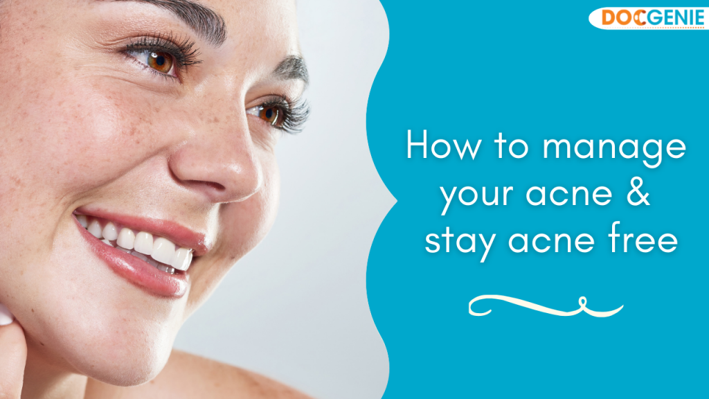 How To Manage Your Acne And Stay Acne Free