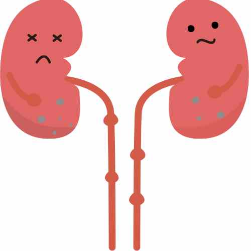 kidney stones
